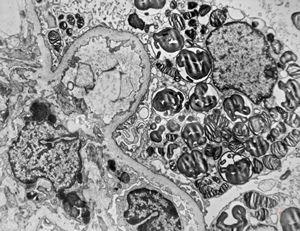 M,27y. | sea-blue histiocyte syndrome